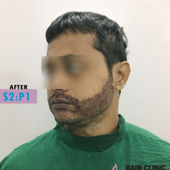 After Beard Transplant Image | Patient 2
