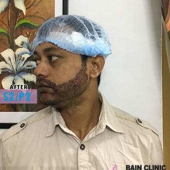 After Beard Transplant Image2 | Patient 2
