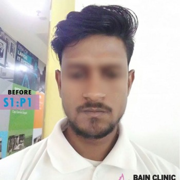 Before Beard Transplant Image | Patient 1
