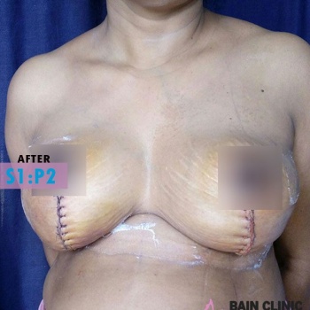 After  Breast Reduction Surgery Image | Patient 1