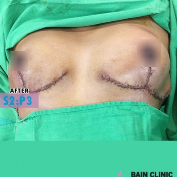 After  Breast Reduction Surgery Image | Patient 2