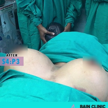After Breast Augmentation Surgery Image | Patient 4