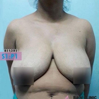 Before  Breast Reduction Surgery Image | Patient 1