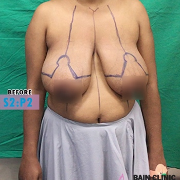 Before  Breast Reduction Surgery Marking Image | Patient 2