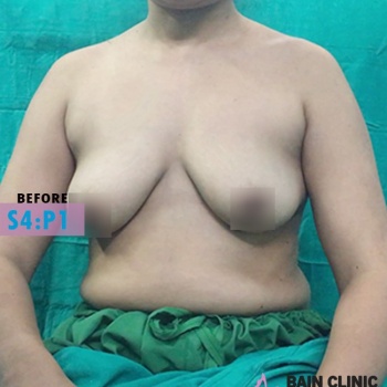 Before Breast Augmentation Surgery Image | Patient 4