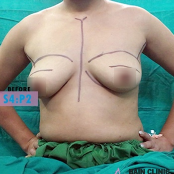 Before Breast Augmentation Surgery Marking Image | Patient 4