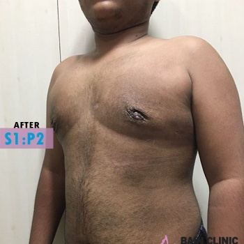 After Gynecomastia Surgery Image | Patient 1