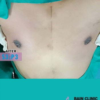 After Gynecomastia Surgery Image | Patient 3