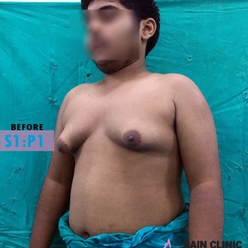 Before Gynecomastia Surgery Image | Patient 1