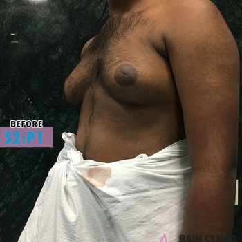 Before Gynecomastia Surgery Image | Patient 2