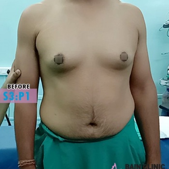 Before Gynecomastia Surgery Image | Patient 3