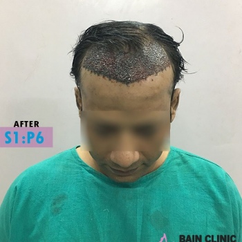 After Hair Transplant Front Area Image | Patient 1