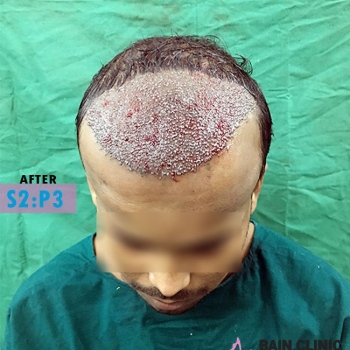 After Hair Transplant Image | Patient 2