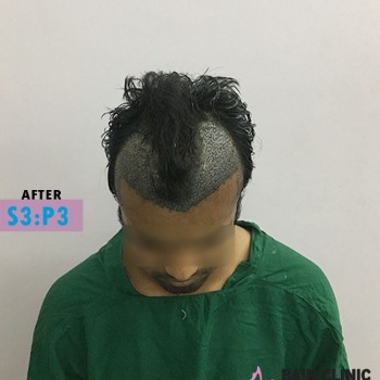 After Hair Transplant Image | Patient 3
