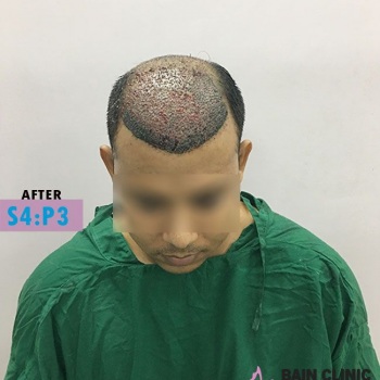 After Hair Transplant Image | Patient 4