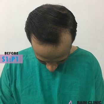 Before Hair Transplant Front Bald Area Image | Patient 1