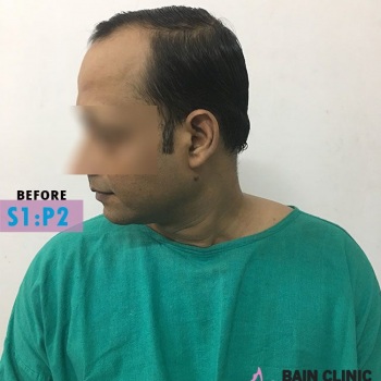 Before Hair Transplant Front Side Bald Area Image | Patient 1