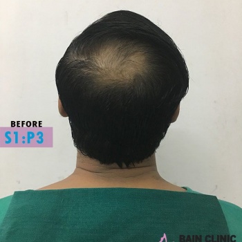 Before Hair Transplant Back Side Bald Area Image | Patient 1