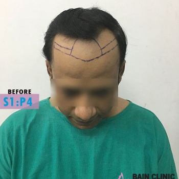Before Hair Transplant Front Side Marking Image | Patient 1