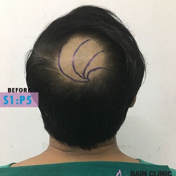 Before Hair Transplant Back Side Marking Image | Patient 1