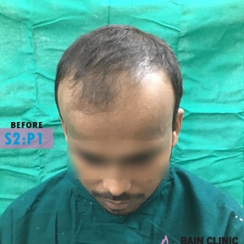Before Hair Transplant Front Side Baldness Image | Patient 2