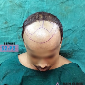 Before Hair Transplant Front Side Marking Image | Patient 2