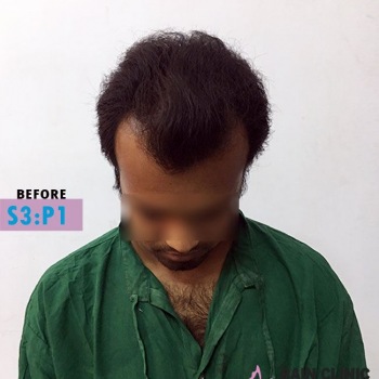 Before Hair Transplant Front Side Baldness Image | Patient 3