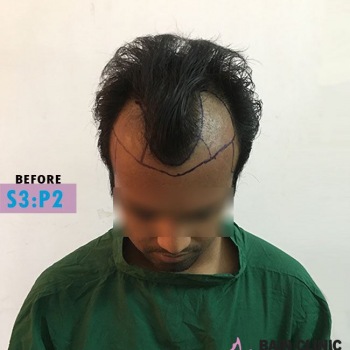 Before Hair Transplant Front Side Marking Image | Patient 3