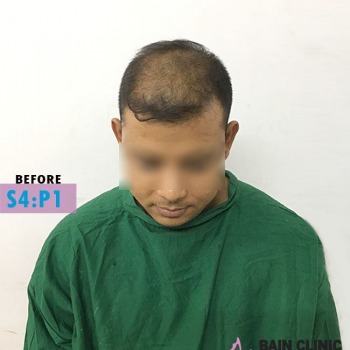 Before Hair Transplant Front Side Baldness Image | Patient 4