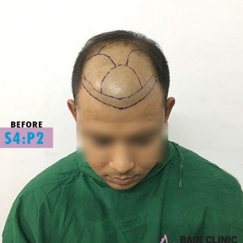 Before Hair Transplant Front Side Marking Image | Patient 4